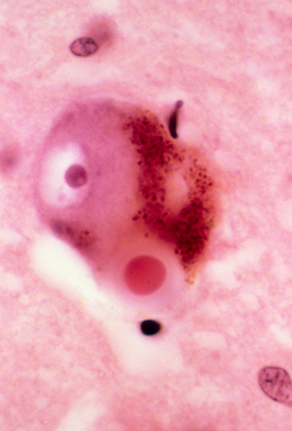 Parkinsonova bolezen nastane zaradi motnje v omrežju nigrostriatnih dopaminergičnih nevronov. | Avtor: Profimedia