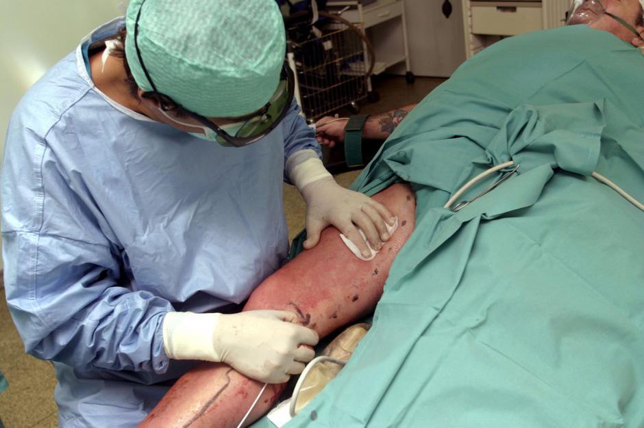 Operacija krčnih žil | Avtor: Profimedias