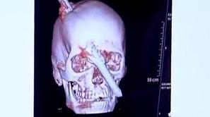 Preživel s palico v glavi 