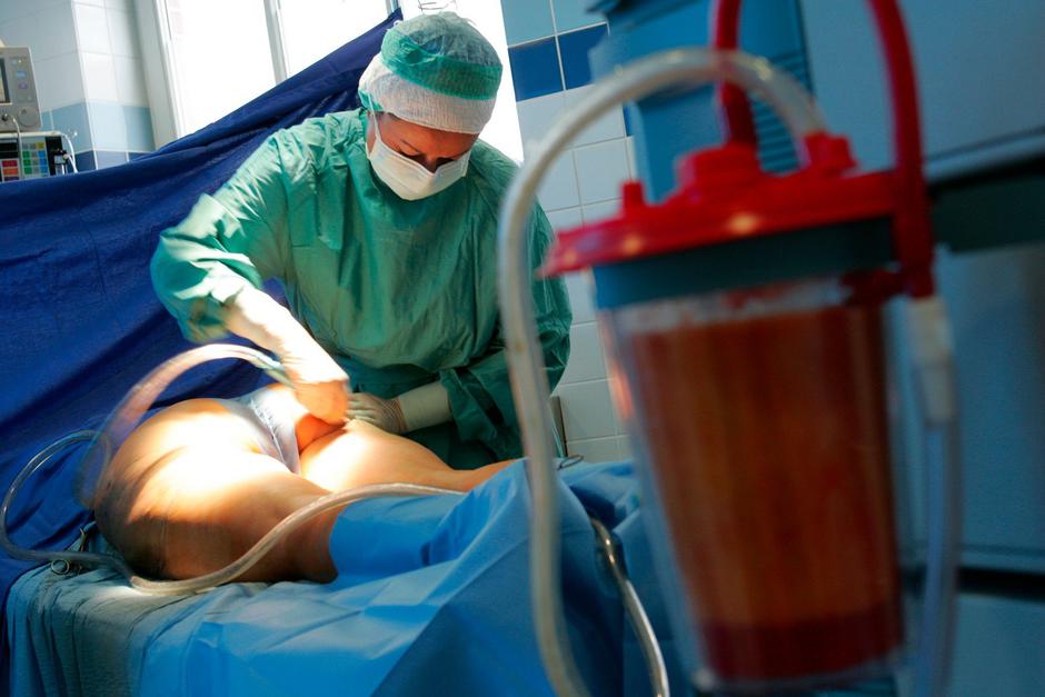 Liposukcija. Fotografija je simbolična- | Avtor: Profimedia
