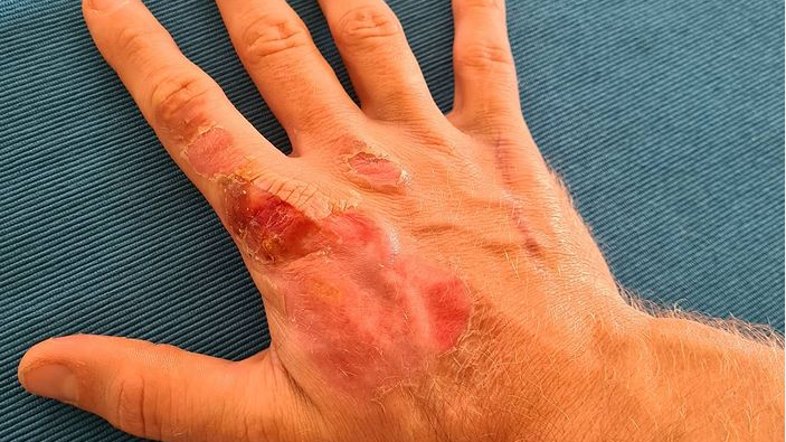 Romain Grosjean, opečena roka