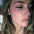 Amber Heard modrice Johnny Depp