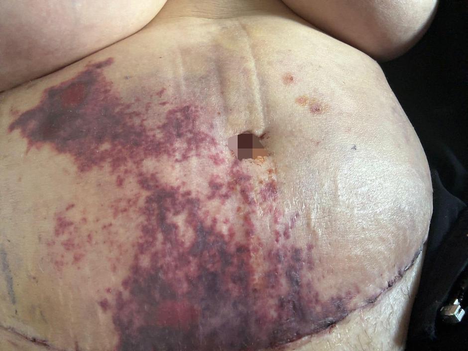 Zapleti po liposukciji | Avtor: Profimedia