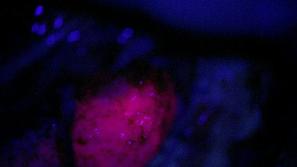 Operacija možganskega tumorja