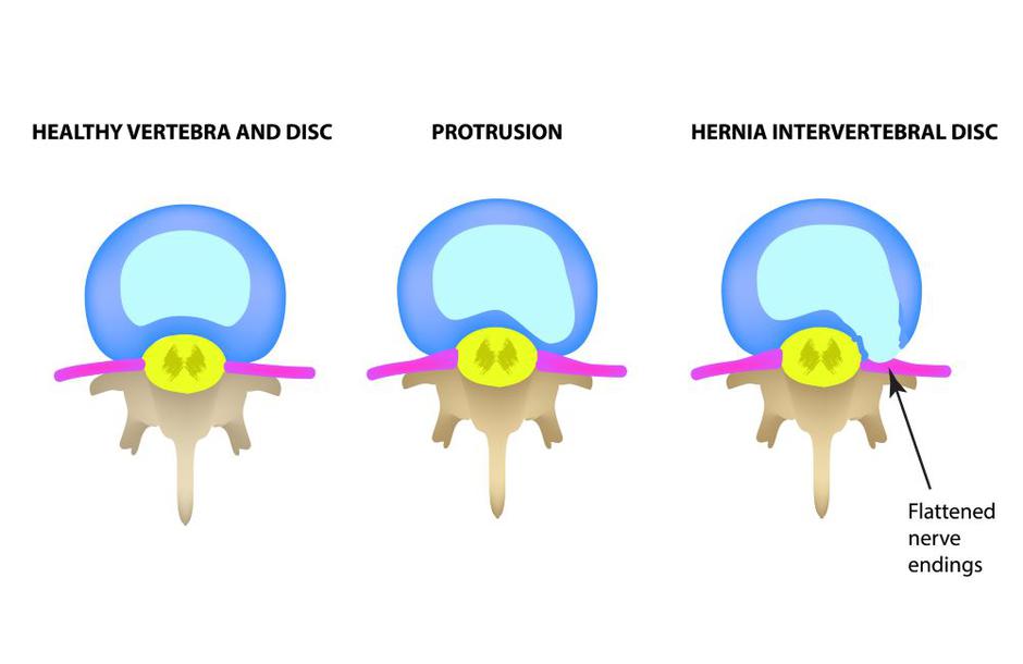 Medicofit, protruzija diska, fizioterapija | Avtor: Medicofit