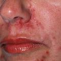 Rosacea