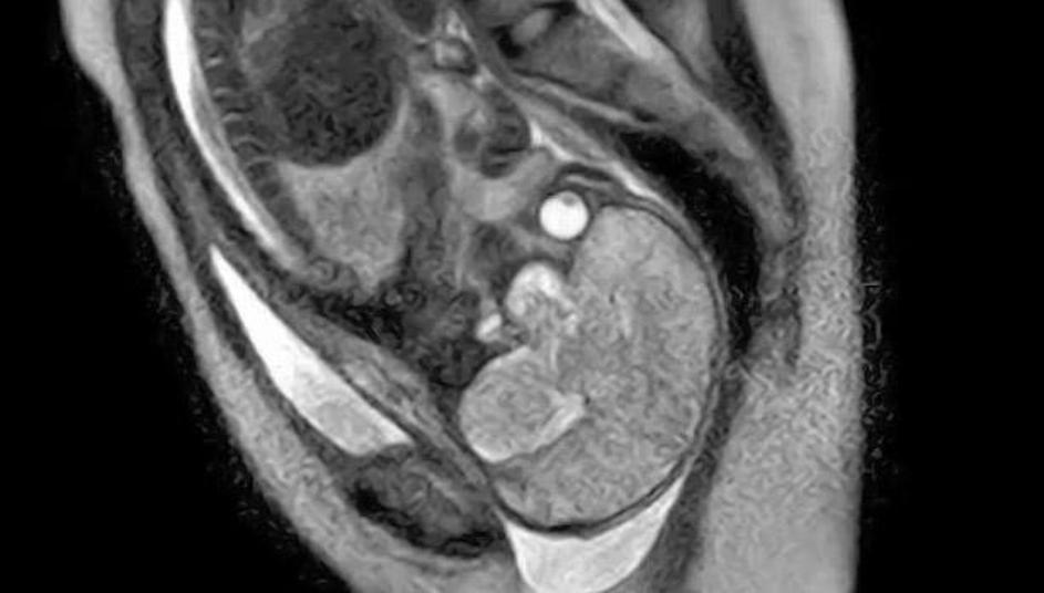 porod, snemanje, magnetna resonanca