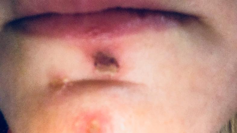 Impetigo