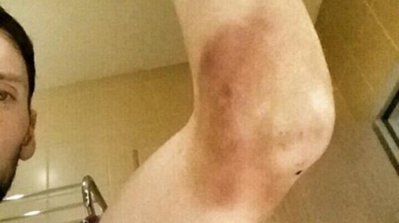 jakov fak komolec poškodba