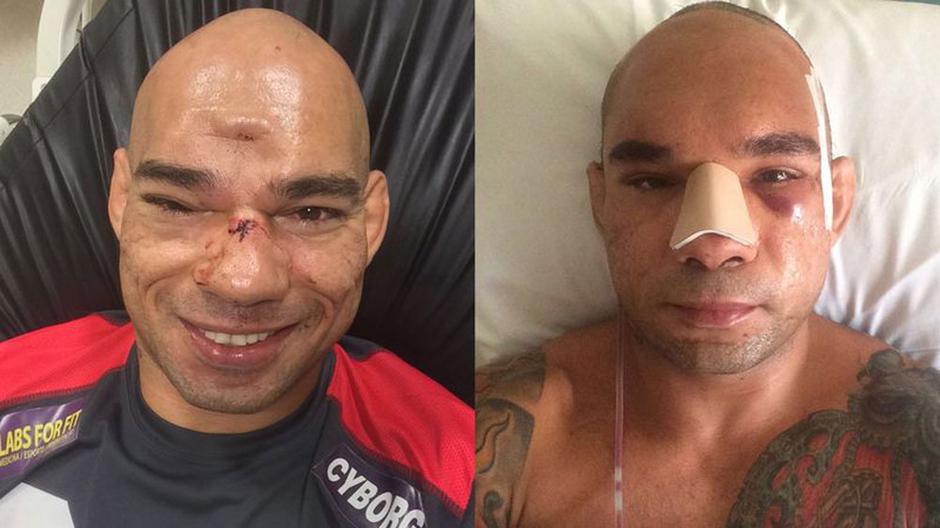 Evangelista Santos zlomljena lobanja | Avtor: Reševalni pas/Twitter