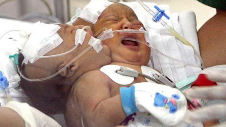 Januarja sta se v indonezijski provinci Aceh rodila dvojčka z enim telesom in dv