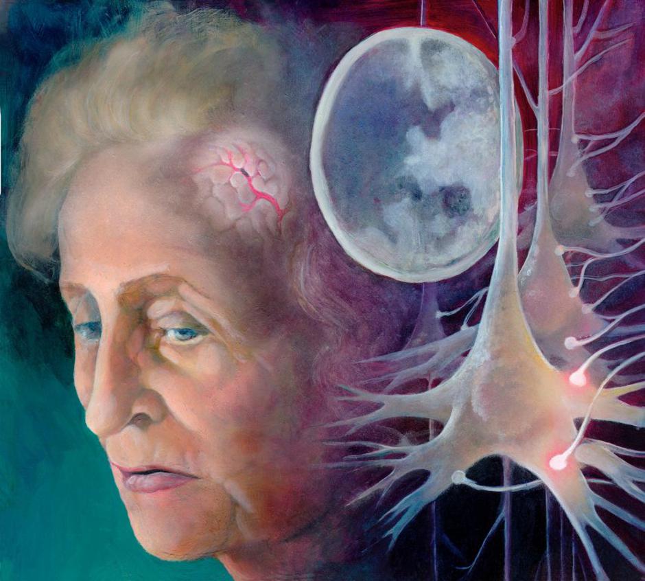 Možganska kap | Avtor: Profimedias