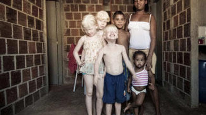 Otroci, ki so v Afriki rojeni kot albini, so pogosto žrtve neumnih vraž. (Foto: 