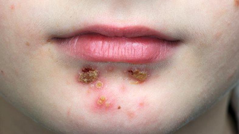Impetigo