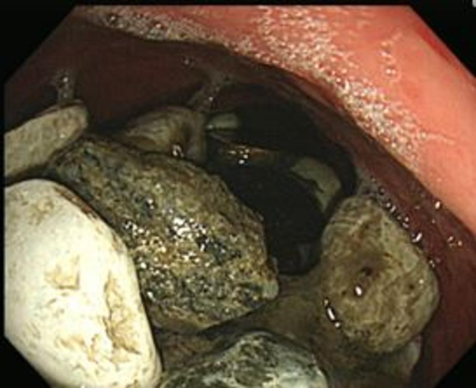 Gastroskopija | Avtor: American Journal of Medical Case Reports