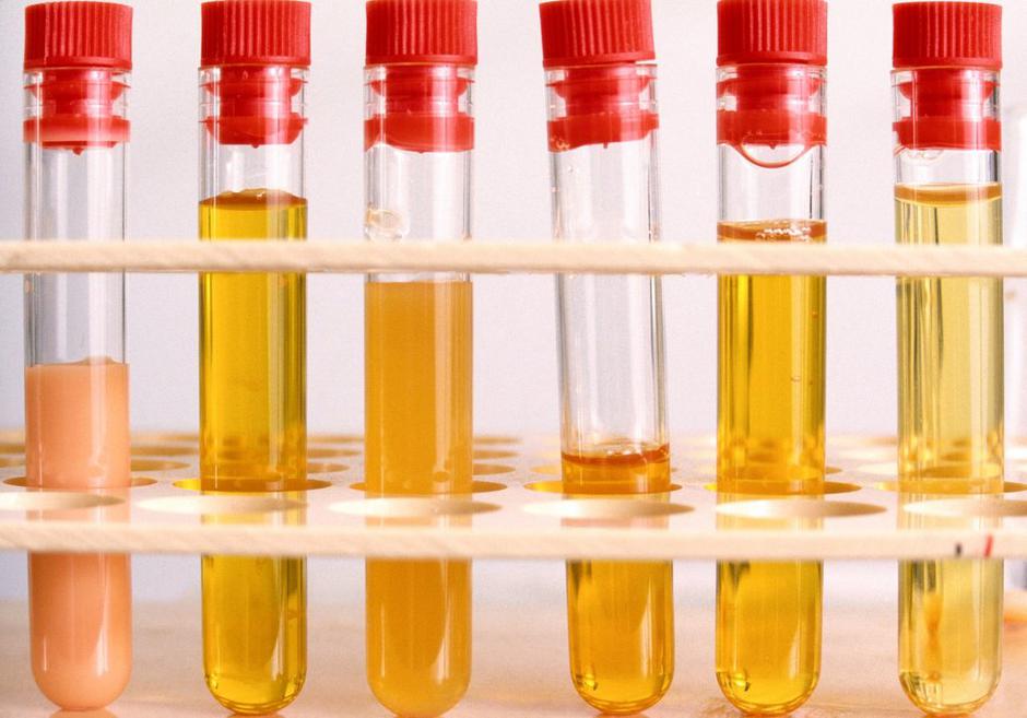 Hiperholesterolemija | Avtor: Profimedia