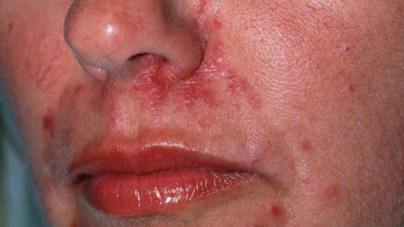 Rosacea