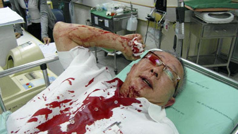 Sondhiju Limthongkulu so iz lobanje odstranili delček krogle in je izven smrtne 