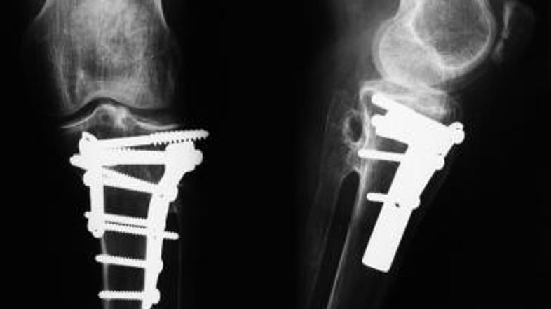 Upokojenec je dolga leta trpel zaradi zlomljenih kosti.