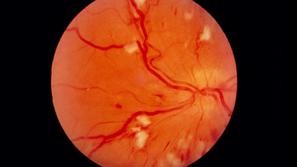 diabetična retinopatija