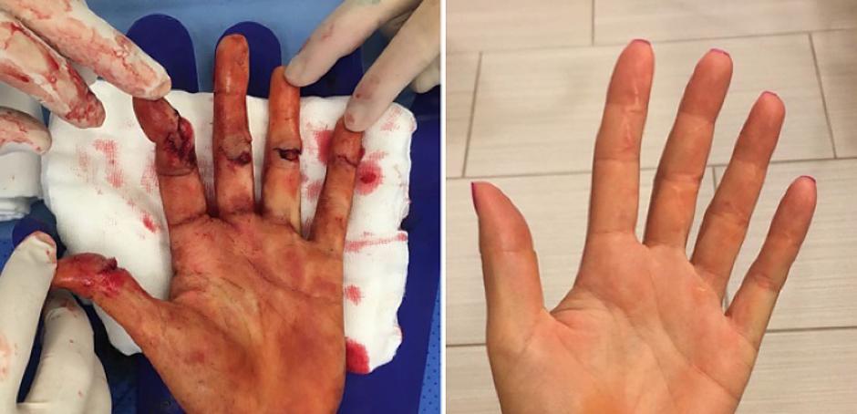 petra kvitova roka | Avtor: Reševalni pas/Twitter