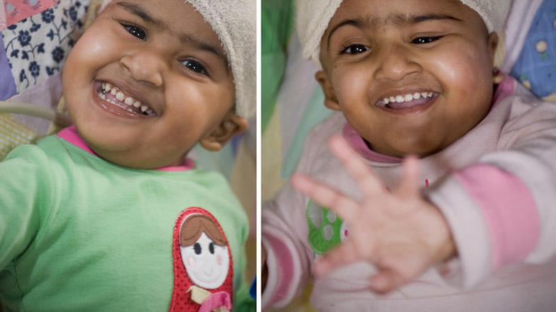 Trishna in Krishna pred zahtevno operacijo avgusta letos. (Foto:) AFP