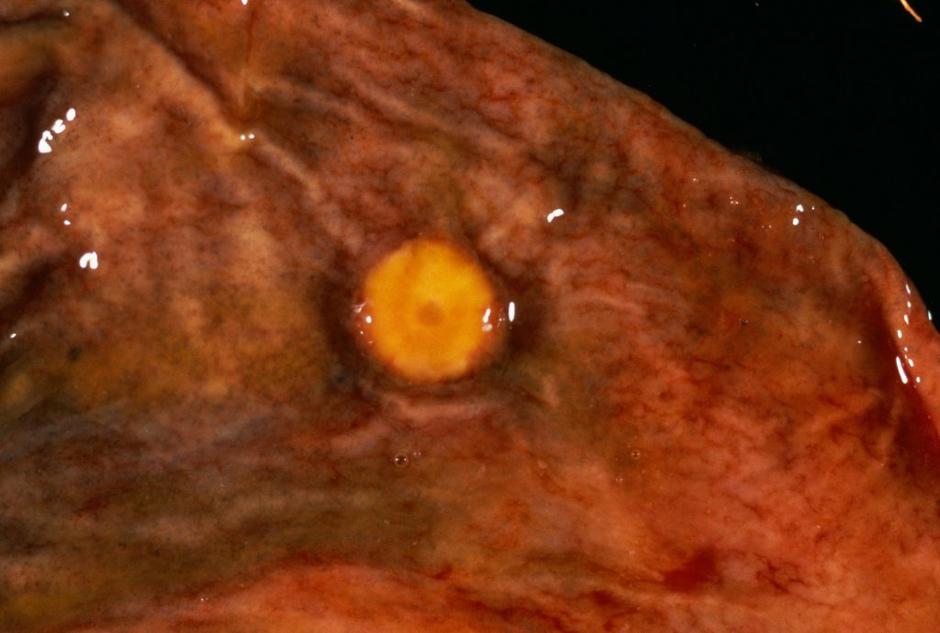 Rak na želodcu | Avtor: Profimedia