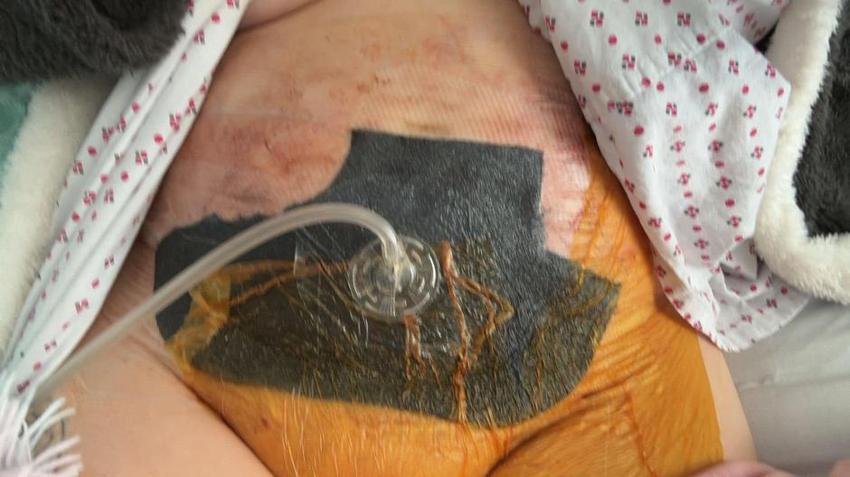 Zapleti po liposukciji | Avtor: Profimedia