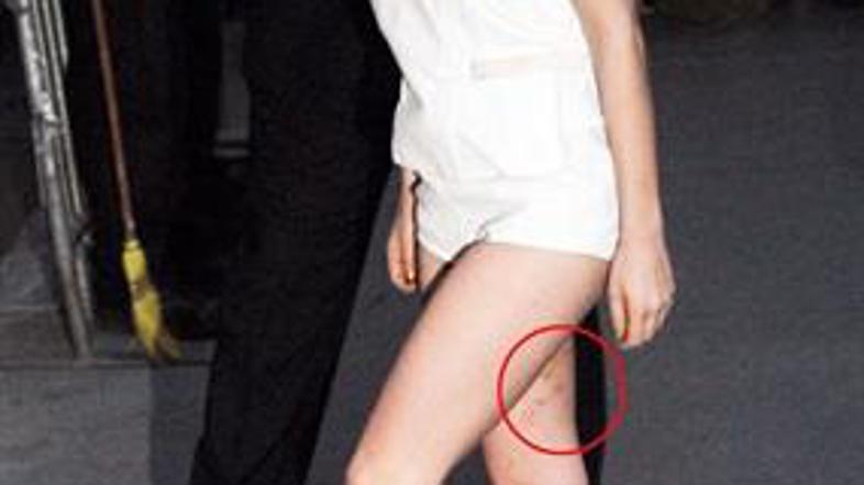 Lady Gaga modrice