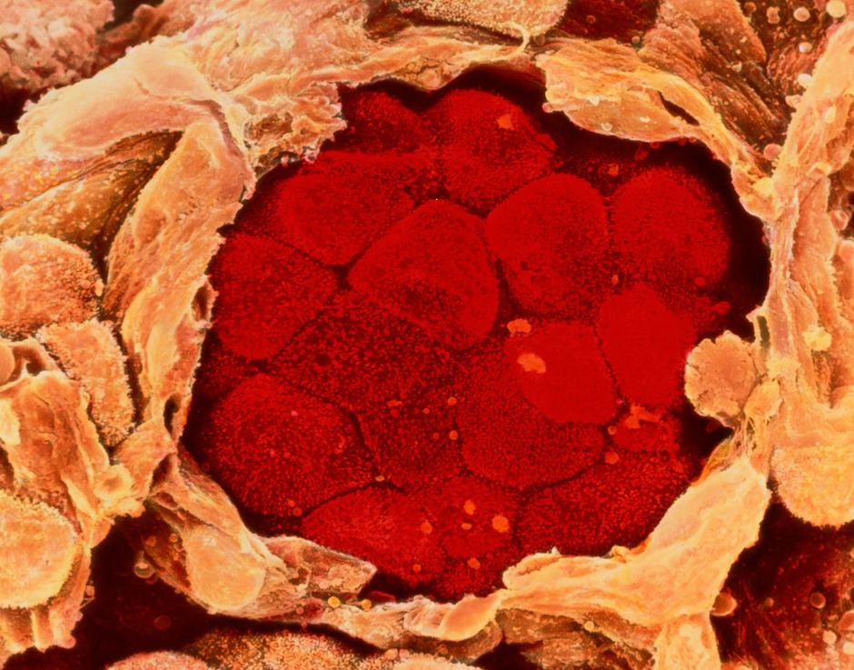 Pljučni rak | Avtor: Profimedia