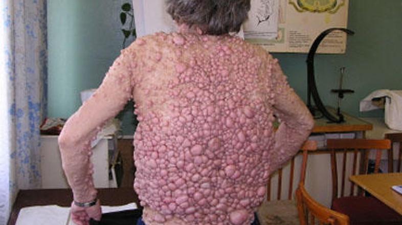 Ahui je podedovala bolezen, multiplo nevrofibromatozo, od svoje mame, ki je tej 
