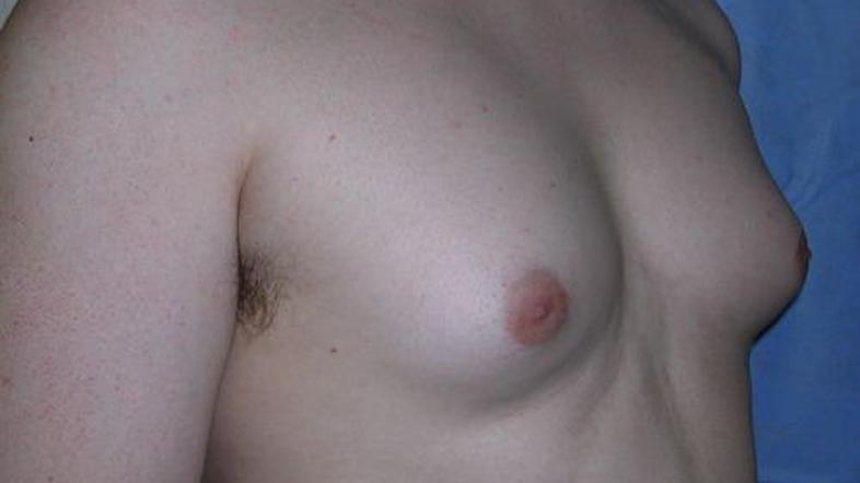 V VB beležijo porast operacij moških prsi.