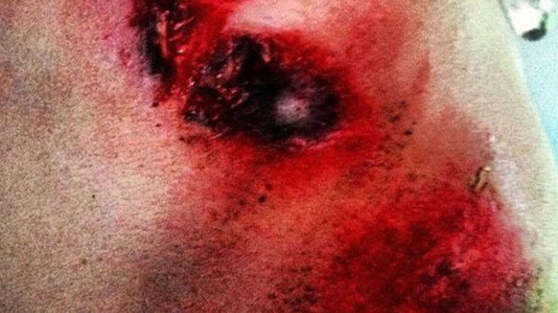 Jani Brajkovič Tour padec rama