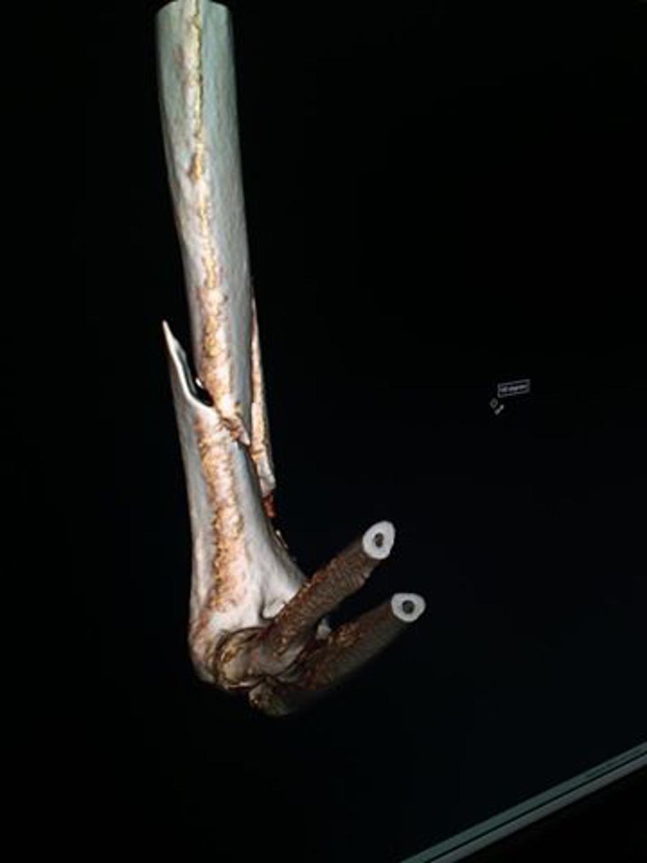 lindsey vonn zlom poškodba | Avtor: Facebook