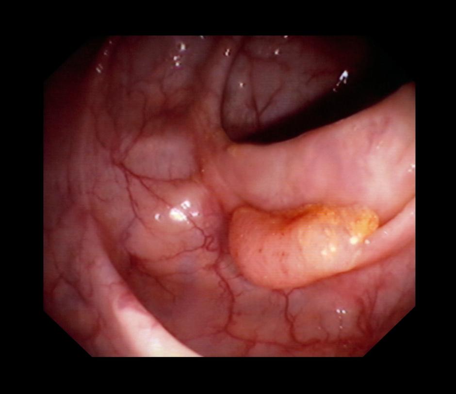 kolonoskopija, lokonografija, rak debelega črevesa in danke, rak, debelo črevo | Avtor: Profimedia