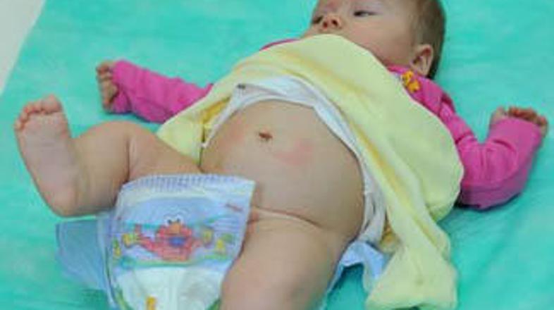 Deklici so tumor na desnem jajčniku odkrili že v maternici v 33. tednu nosečnost