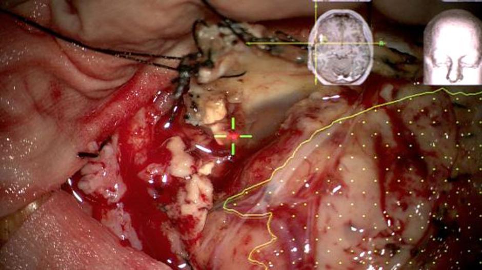 Operacija možganskega tumorja | Avtor: UKC Ljubljana