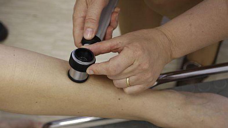 Skupaj so dermatologi zadnji dan v maju pregledali okoli 400 ljudi.