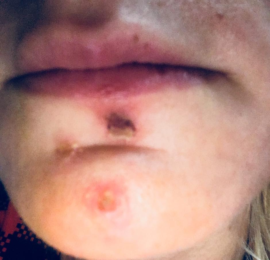 Impetigo | Avtor: A. Š.