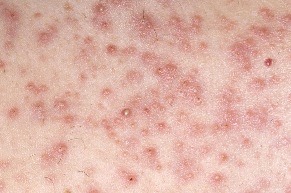 Folikulitis | Avtor: Profimedia