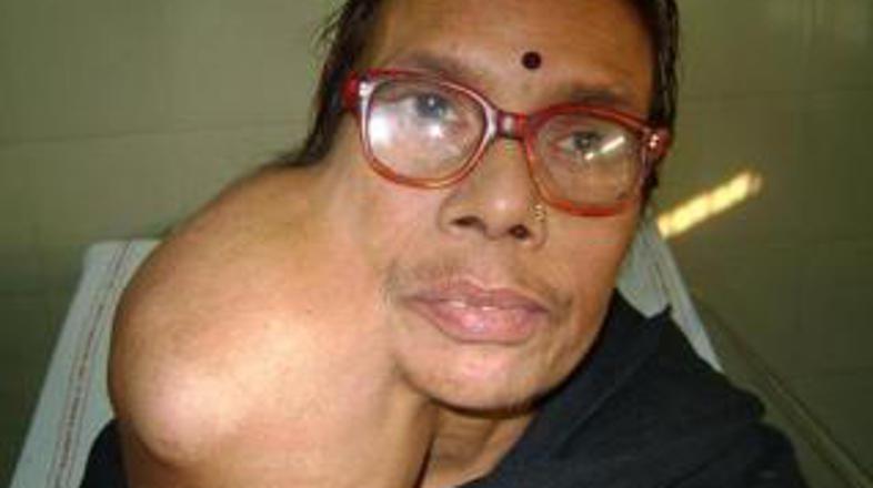 67-letna Indijka je z odstranitvijo tumorja odlašala tako dolgo, ker se je bala,