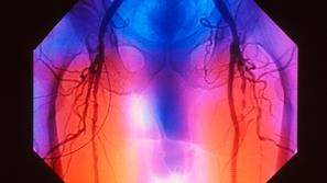 Periferna arterijska bolezen