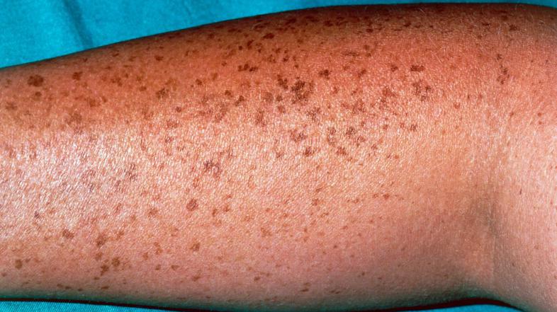 roka, pege, zmanemnja, rak