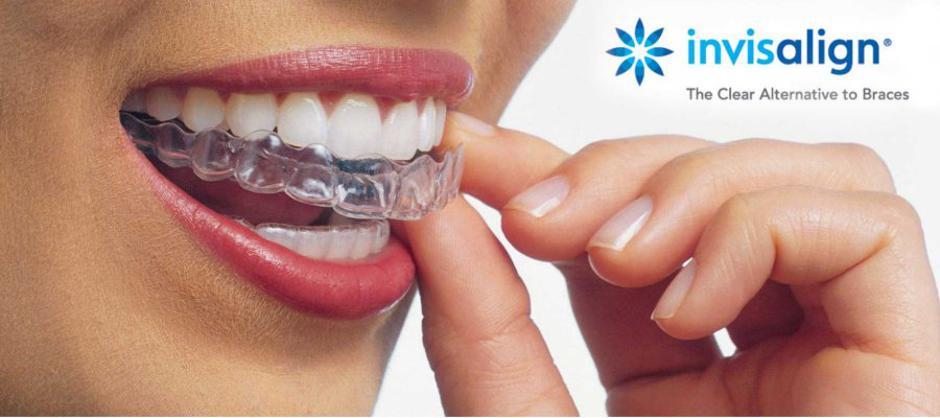 invisalign, zobje, estetetika, zdravje | Avtor: Invisalign