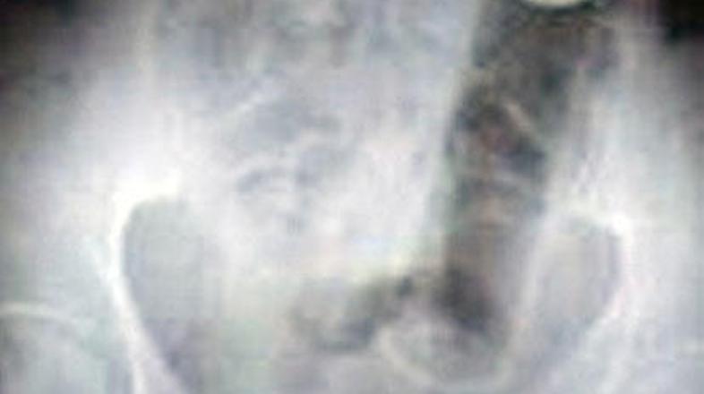 Rentgenska slika je pokazala, da ima pacientka v anusu veliko pločevinko.