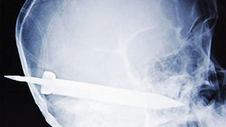 Mladenič je z nožem v glavi prikorakal v bolnišnico.