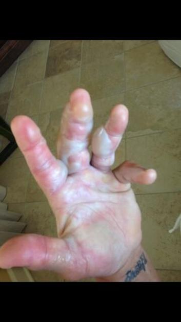 Hulk Hogan, prsti, opeklina