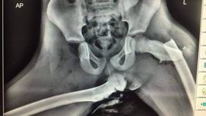 Rentgenski posnetek noge na armaturki