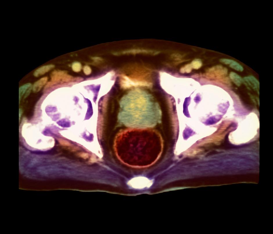 Rak prostate | Avtor: Profimedia