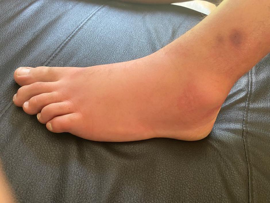 Ugriz obada | Avtor: A. Š.